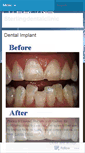 Mobile Screenshot of implantologistindelhi.wordpress.com